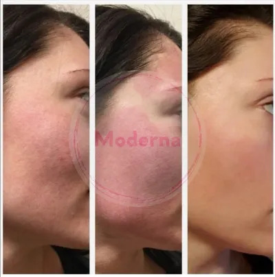resultats-microneedling