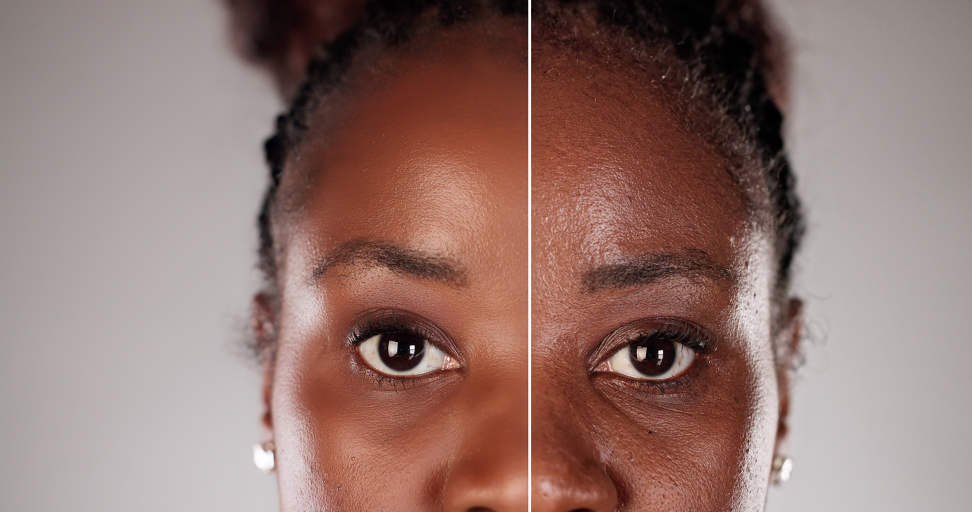 Youthful Transformation: A Brighter Future for Your Skin with Anti-Wrinkle Treatment Before and After Photos