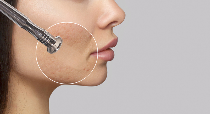 Woman with problem skin.The cosmetologist makes the procedure Microdermabrasion of the face skin of a beautiful woman in a beauty salon.Cosmetology and professional skin care.